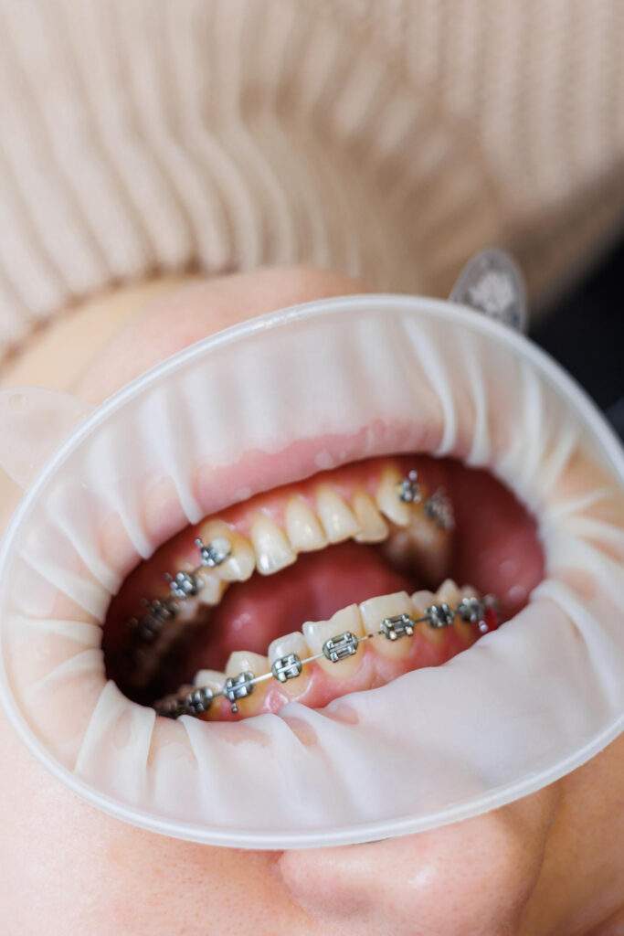 Ortodoncia del canino incluido en Boadilla del Monte